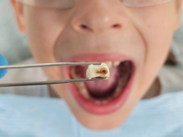 Best Emergency Tooth Extraction in Tontitown, AR